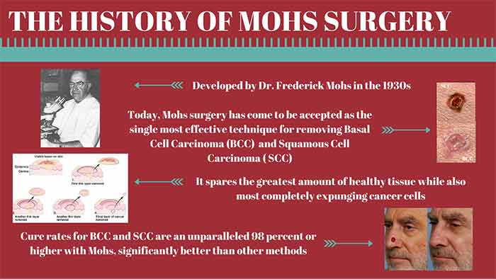 History of Mohs Surgery | Contour Dermatology History of Mohs Surgery