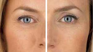 Juvederm Before/After Gallery