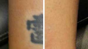 Laser Tattoo Removal Before/After Gallery