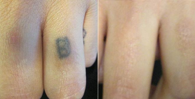 Laser Tattoo Removal on Finger Before and After
