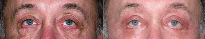Fractional CO2 for Eyes
