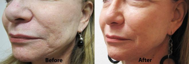 Restylane for Cheeks
