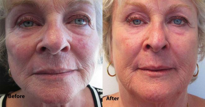 Restylane for Cheeks