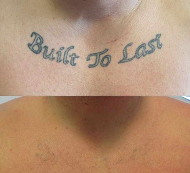 Tattoo Removal on Chest Before and After