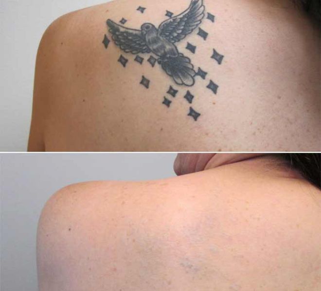 Tattoo Removal on Back Before and After