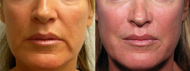 Restylane Before and After