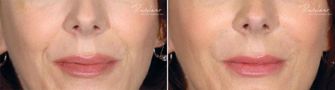 Restylane for lips