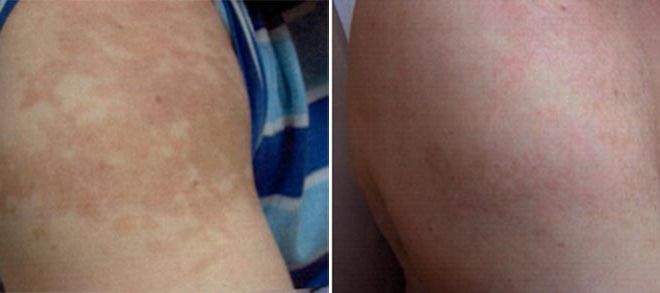 Tattoo Removal on Shoulder Before and After