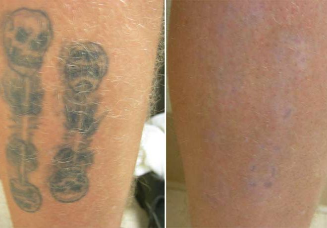 Tattoo Removal on Calf Before and After