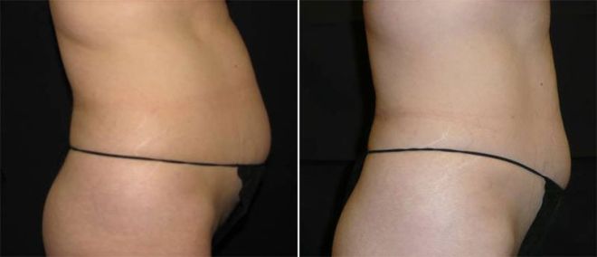 Velashape III Liposuction Before and Afte