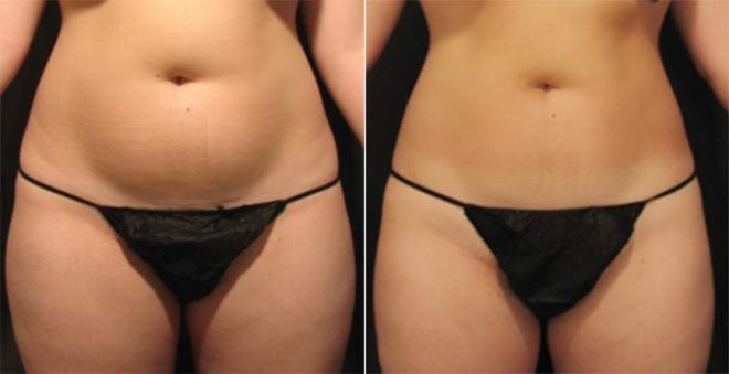 Velashape III Liposuction Before and After