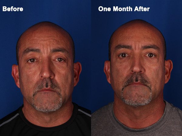 fat-transfer-before-after | Contour Dermatology Fat Transfer Before and After