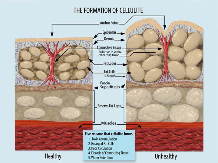 Cellulite Infographic