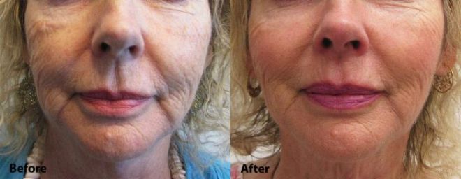 Restylane Lyft for cheeks before and after