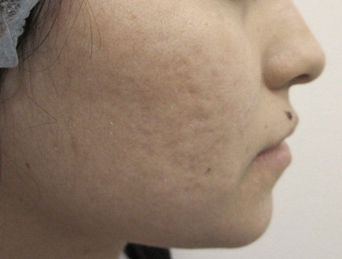 Woman Acne Scars After Smoothbeam Laser