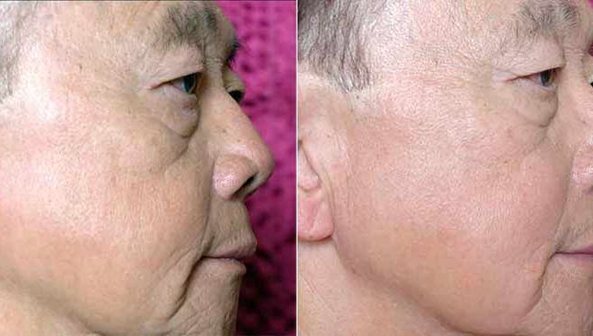 Sublime Before and After