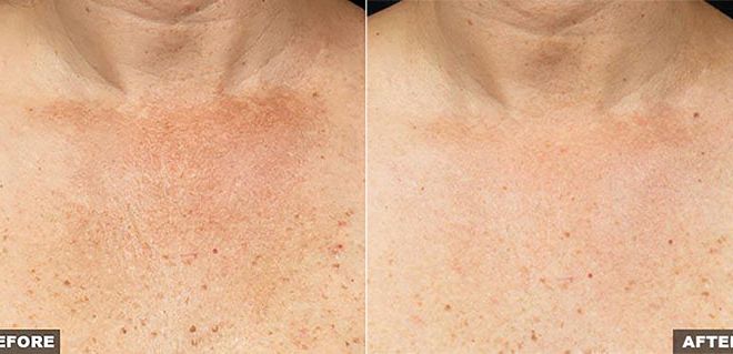 Fraxel for Decolletage