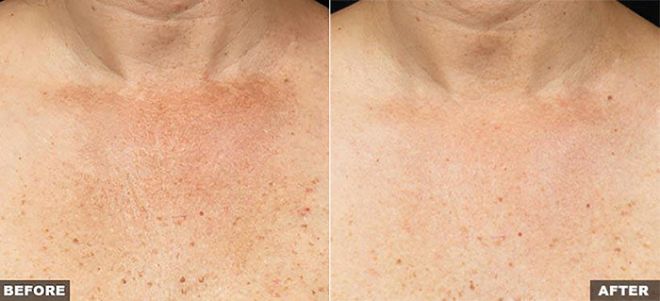 Fraxel for Decolletage
