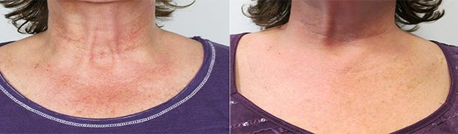 Fraxel for Décolletage