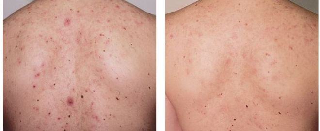 Back Acne Scars Treatment, Before & After