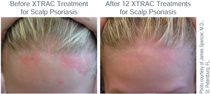 XTRAC lASER for Psoriasis, Read More