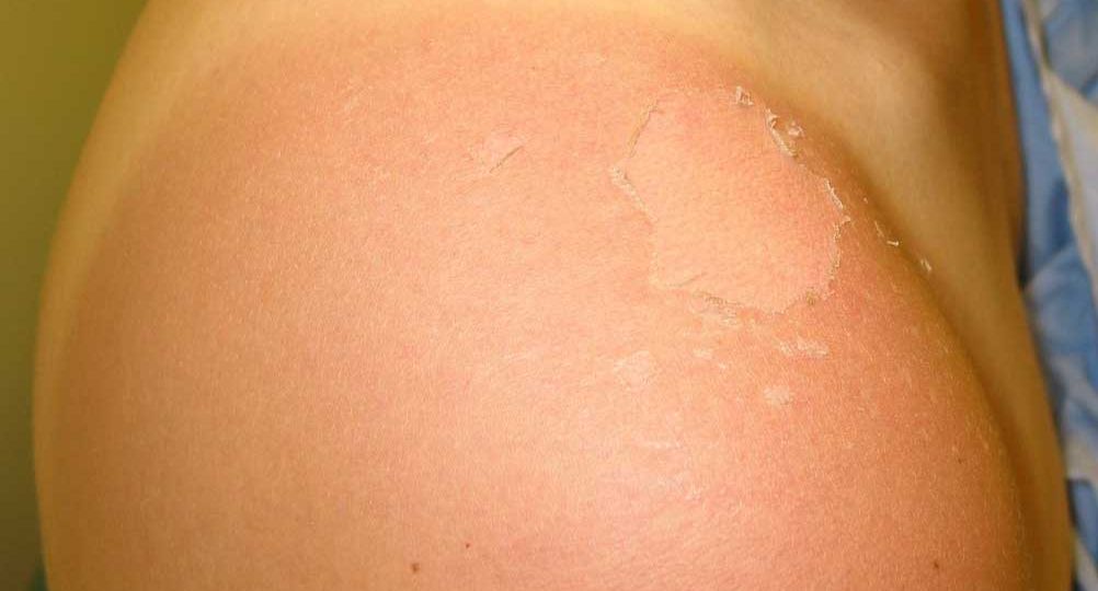 Photo of a Sunburn on shoulder