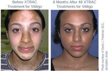 XTRAC Laser for Vitiligo, Read More