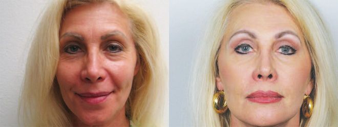 Upper and Lower Eyelid Surgery (Upper and Lower Blepharoplasty)