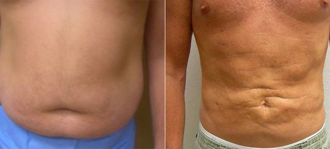 Velashape III and Liposuction Before and After