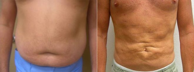 Velashape III and Liposuction Before and After