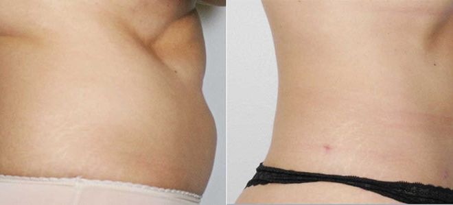 Liposuction Before and After