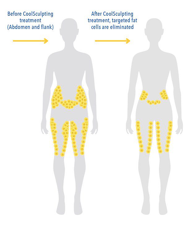 CoolSculpting Fat Cell Removal Diagram