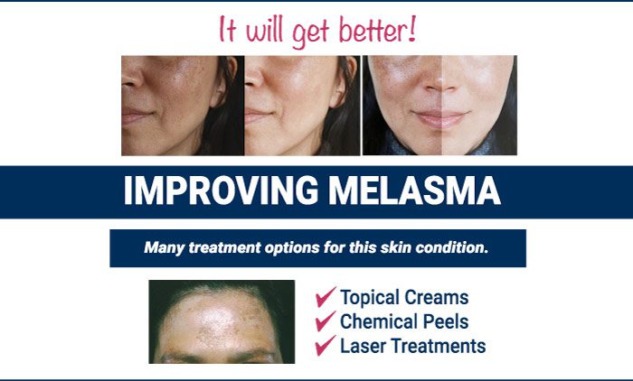 Improving Melasma, it will get better!