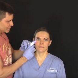 In this video Dr Timothy Jochen demonstrates how easy it is to reduce Crow's feet with Botox injections. Crow's feet are those little wrinkles we get near the corner of our eyes. They make us look older than we actually are.