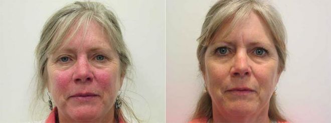 Excel-V and Chemical Peel Before and After