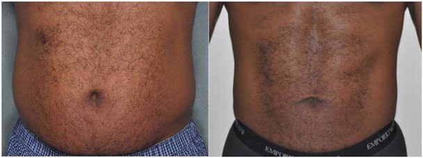 Men need liposuction too, call us at 760-423-4000