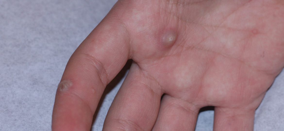 Photo of a wart on the hand.