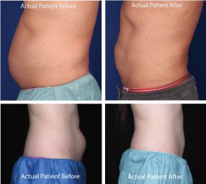 CoolSculpting Before & After Photos