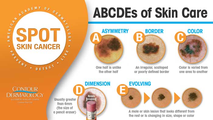 Types of Skin Cancer and how to detect them | Contour Dermatology Types of Skin Cancer and how to detect them