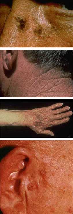 Images of Actinic Keratosis Patients