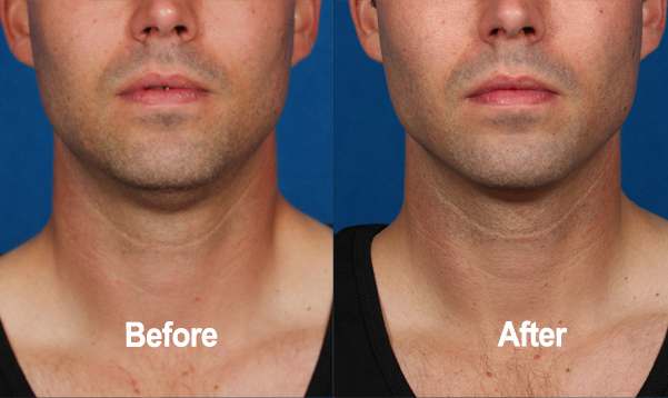 Kybella, Before and After, Actual Patient, Front View, Male