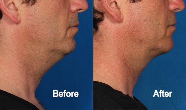 Kybella, Before and After, Actual Patient, Side View, Male