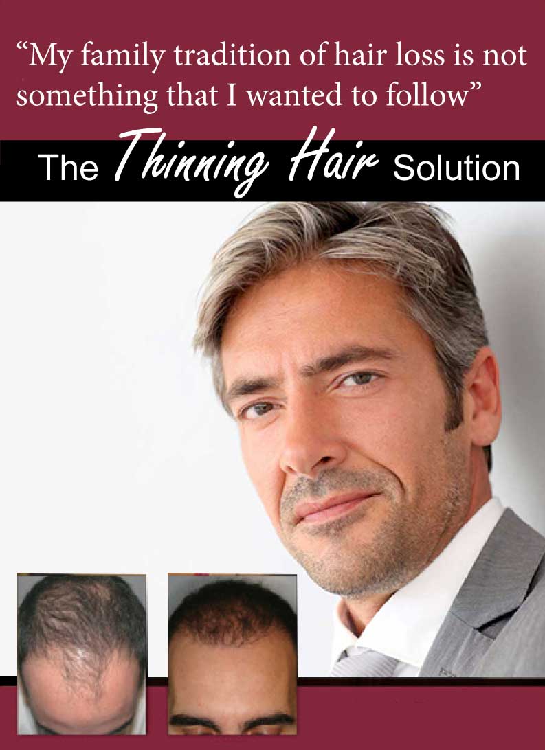 NeoGraft, the game changer in hair transplant
