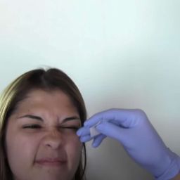 Botox Injection Demonstration, Reduce Bunny lines & Facial Wrinkles