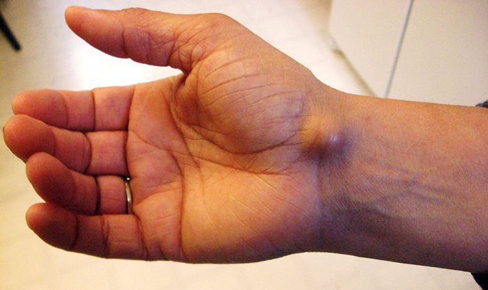 An example of a ganglion cyst