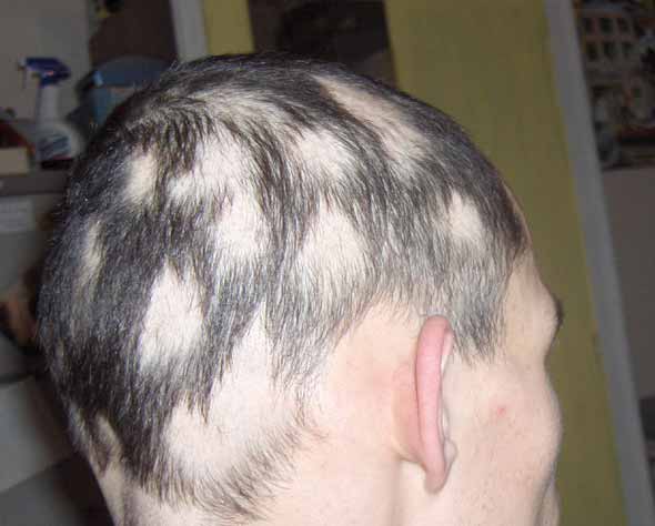 Alopecia Areata | Contour Dermatology Alopecia Areata