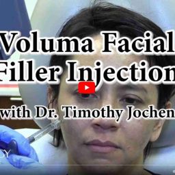 Voluma Facial Filler Injection
