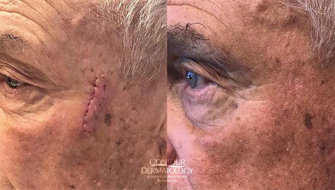 Male patient, scar revision on face after Mohs Surgery