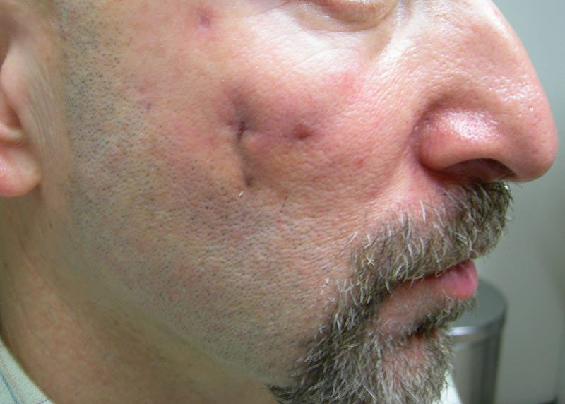 Example of a treatable scar.