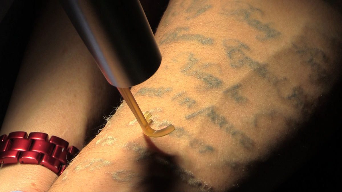 PicoWay Tattoo Removal Laser action | Contour Dermatology PicoWay Tattoo Removal Laser action